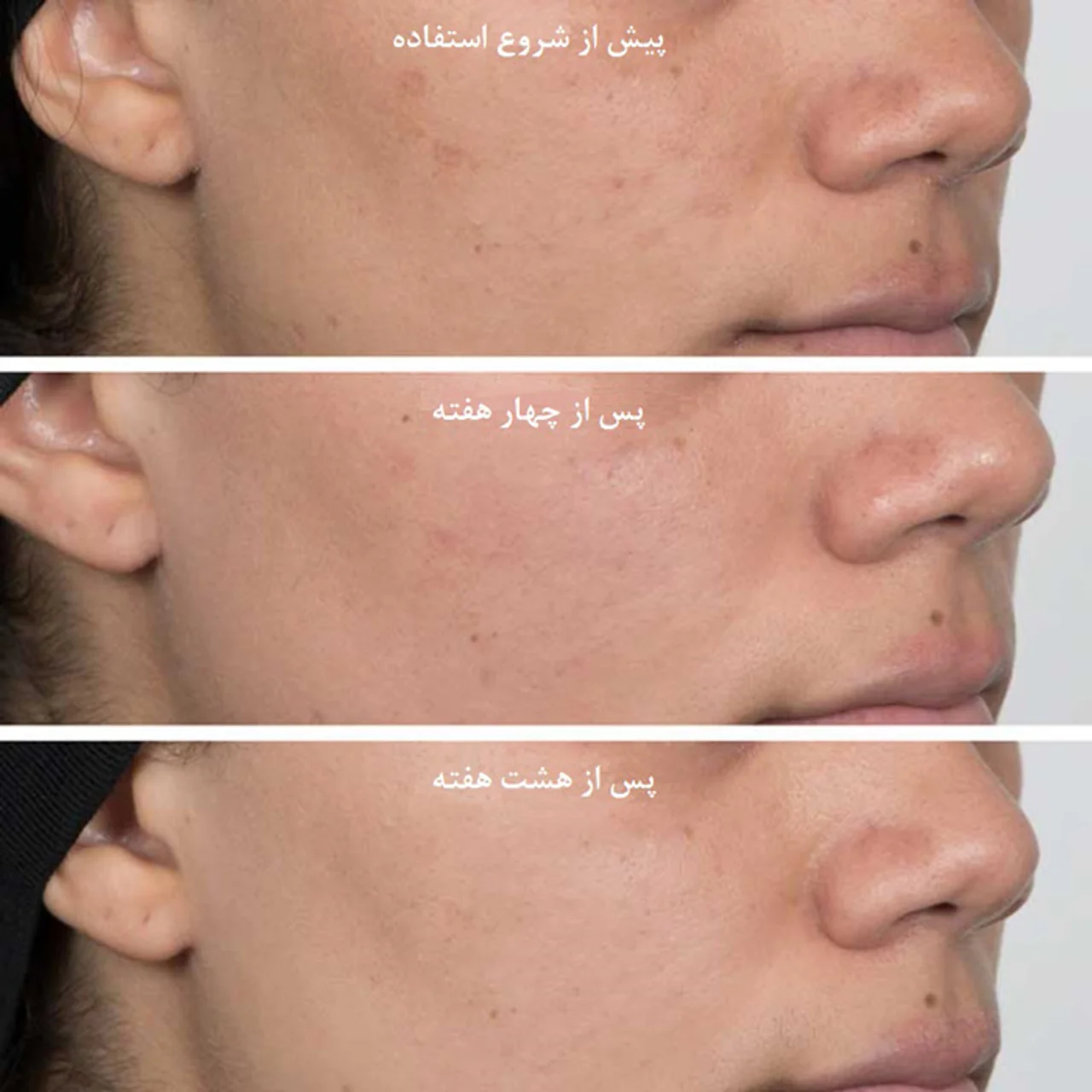 منافذ باز پوست, آیا واقعاً نیاسینامید موثر است؟