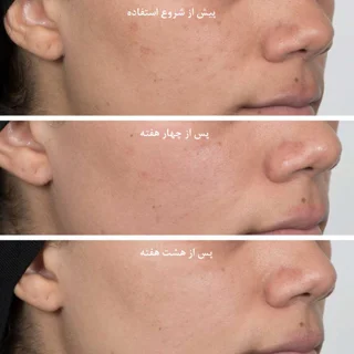 منافذ باز پوست, آیا واقعاً نیاسینامید موثر است؟